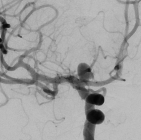 De-identified DSA image, case 61, view a